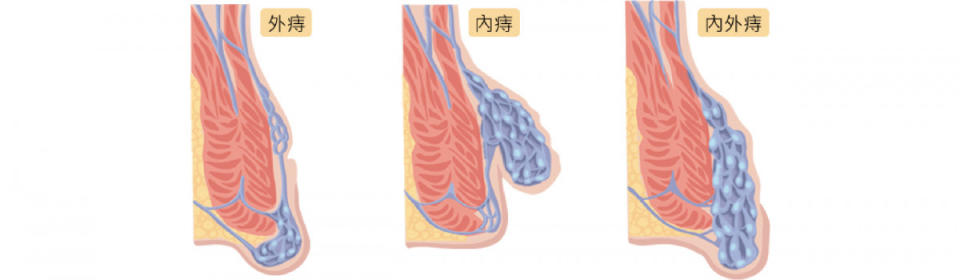 痔瘡種類。（圖／禾馨直腸外科）