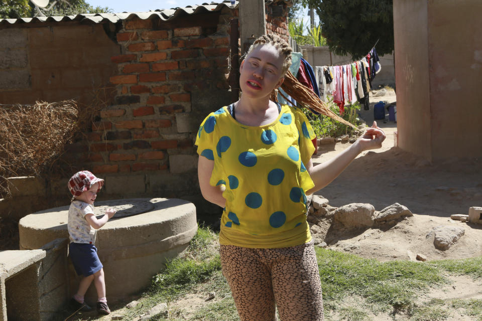 Marcia Mandizha, right, and her little brother Tendai pose for a photo at their family home in Chitungwiza on the outskirts of Harare, in this Tuesday, June 9, 2020 photo. The two siblings are part of Joyce Muchenje's three children, who all have albinism. Muchenje used to provide for them by washing laundry and household cleaning for cross border traders at a busy border town before the lockdown, but now the border trade has stopped and Mutenje has run out of money to get the skin cream for her children. (AP Photo/Tsvangirayi Mukwazhi)
