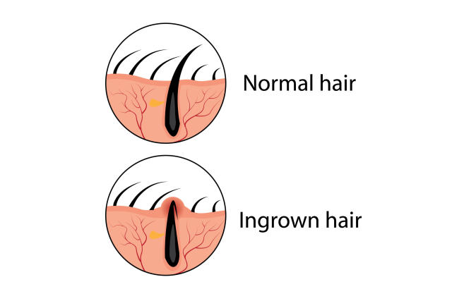 plucked hair follicle ingrown