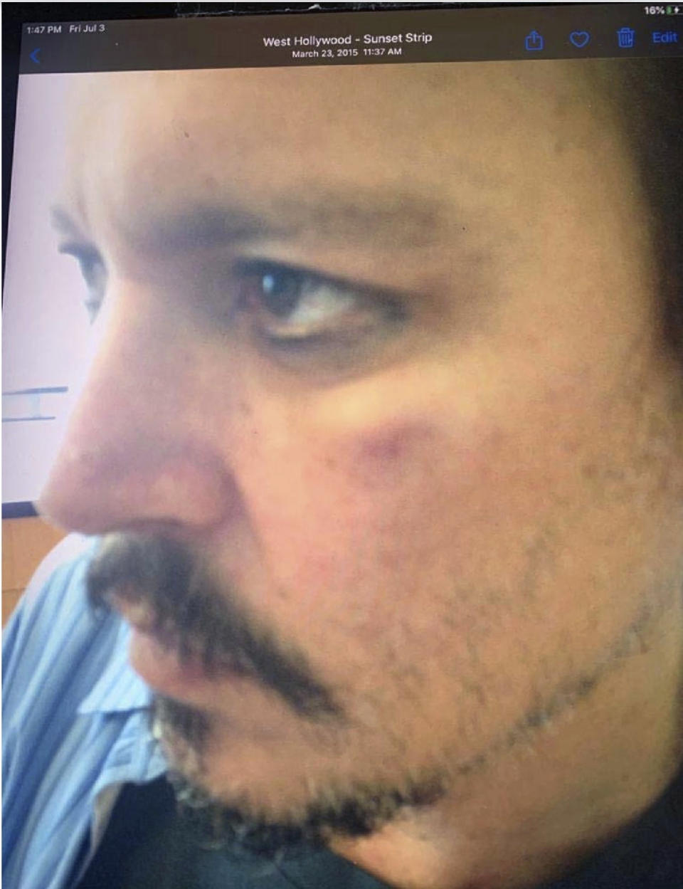 In this photo provided by London High Court on Thursday, July 16, 2020, actor Johnny Depp with injuries allegedly sustained from Amber Heard during an incident in Los Angeles in March 2015, which was filed with the witness statement of Sean Bett, and has been referred to as an exhibit in the hearing of Depp's libel case at the High Court in London. Depp is suing News Group Newspapers, publisher of The Sun, and the paper’s executive editor, Dan Wootton, over an April 2018 article that called him a “wife-beater.” The Sun’s defense relies on a total of 14 allegations by his ex-wife Amber Heard of Depp’s violence. He strongly denies all of them. (London High Court via AP)