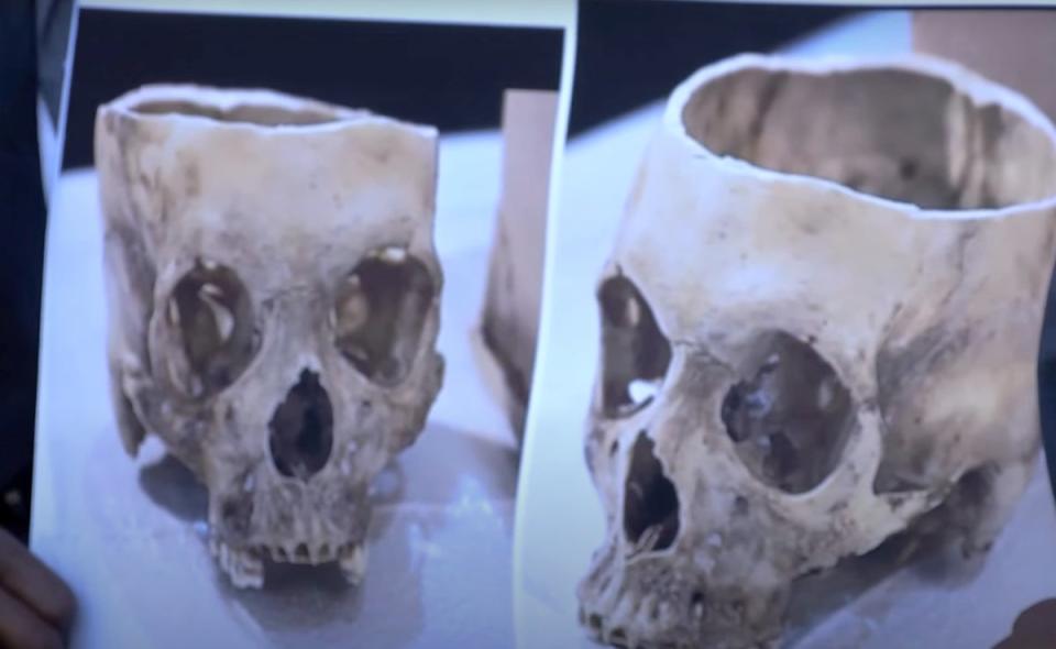 Images of Rasheem Carter’s skull are shown at a press conference (ABC24)