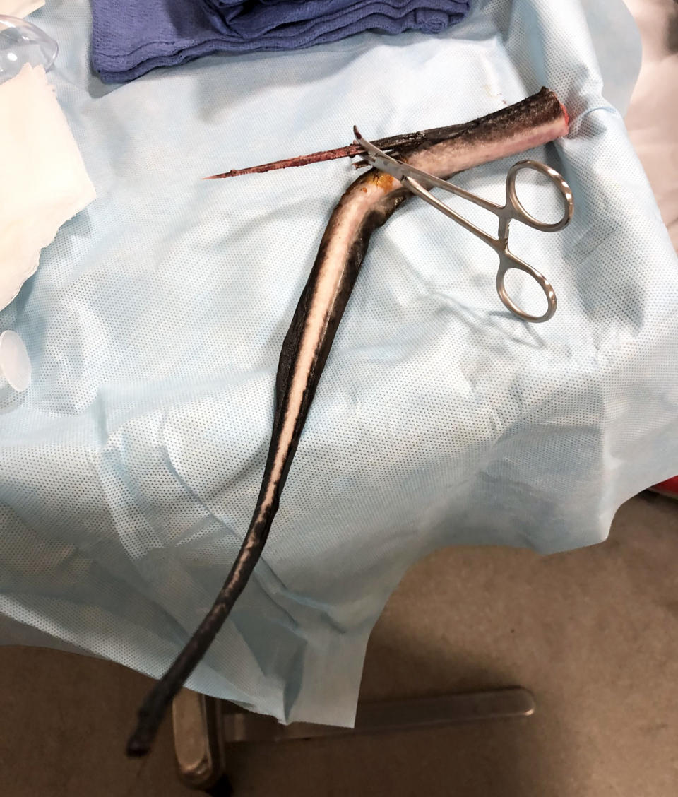 The barb tore through muscles, tissue and nerve endings. (Courtesy Kristie Cataffo-O’Brien)