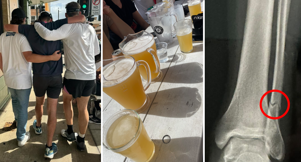 Lachy is helped to walk with two friends by his side (left) with jugs of beer on the table at the pub (middle). Right, the X-ray shows the complete break of his fibula. 