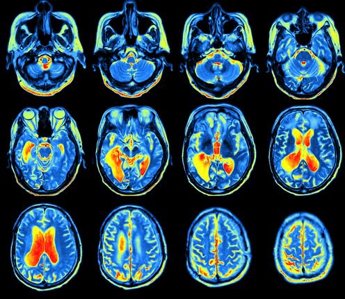 <span class="caption">MRI scan of the brain.</span> <span class="attribution"><a class="link " href="https://www.shutterstock.com/download/confirm/590081462?src=49avW3pm8XvCQV2A-X3eOg-1-3&size=huge_jpg" rel="nofollow noopener" target="_blank" data-ylk="slk:MRIman;elm:context_link;itc:0;sec:content-canvas">MRIman</a></span>