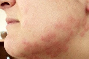 Bed bug bites on a person's jawline, face and neck.