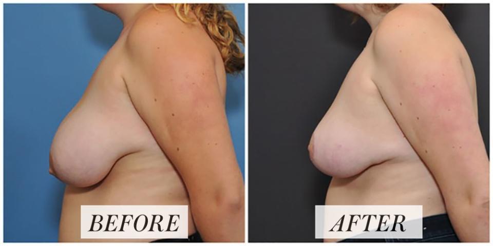 <h1 class="title">Life in Plastic: Breast Reduction Surgery Before-and-After Images.jpg</h1><cite class="credit">Courtesy of David Sieber</cite>