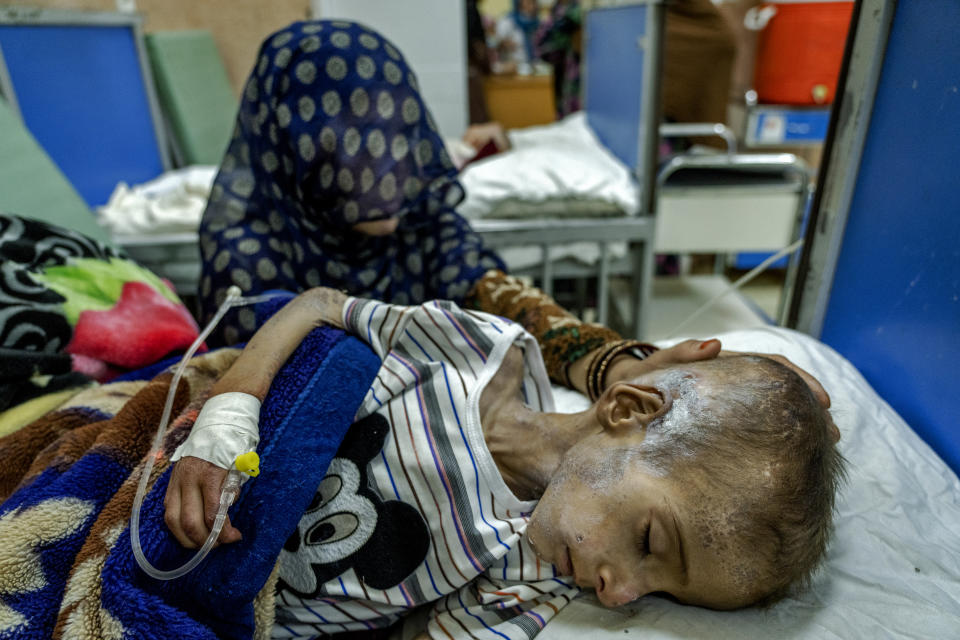 FILE - An Afghan mother helps her acutely malnourished boy at the Indira Gandhi Hospital in Kabul, Afghanistan, Sunday, May 22, 2022. Some 1.1 million Afghan children under five will face malnutrition by the end of the year, as hospital wards are already packed with sick children. (AP Photo/Ebrahim Noroozi, File)