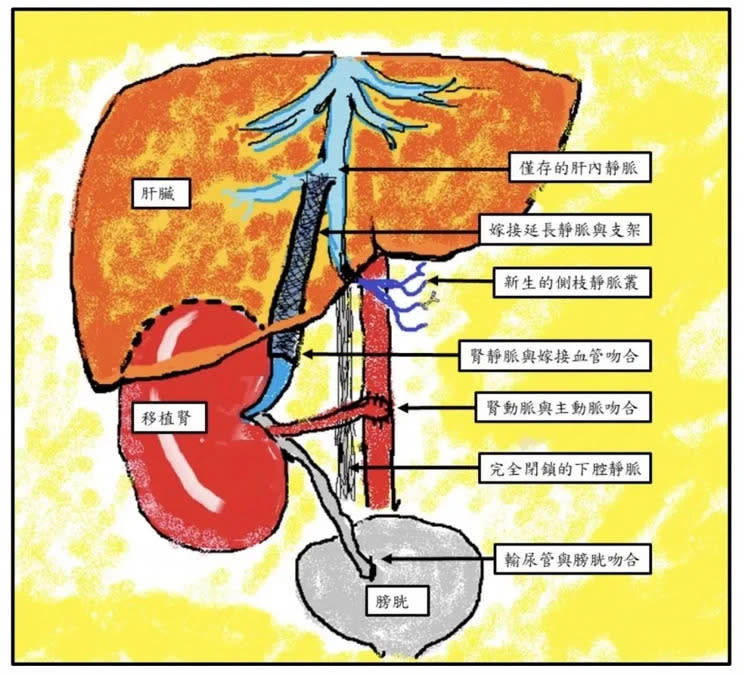 將腎臟種在肝臟上，延長嫁接血管