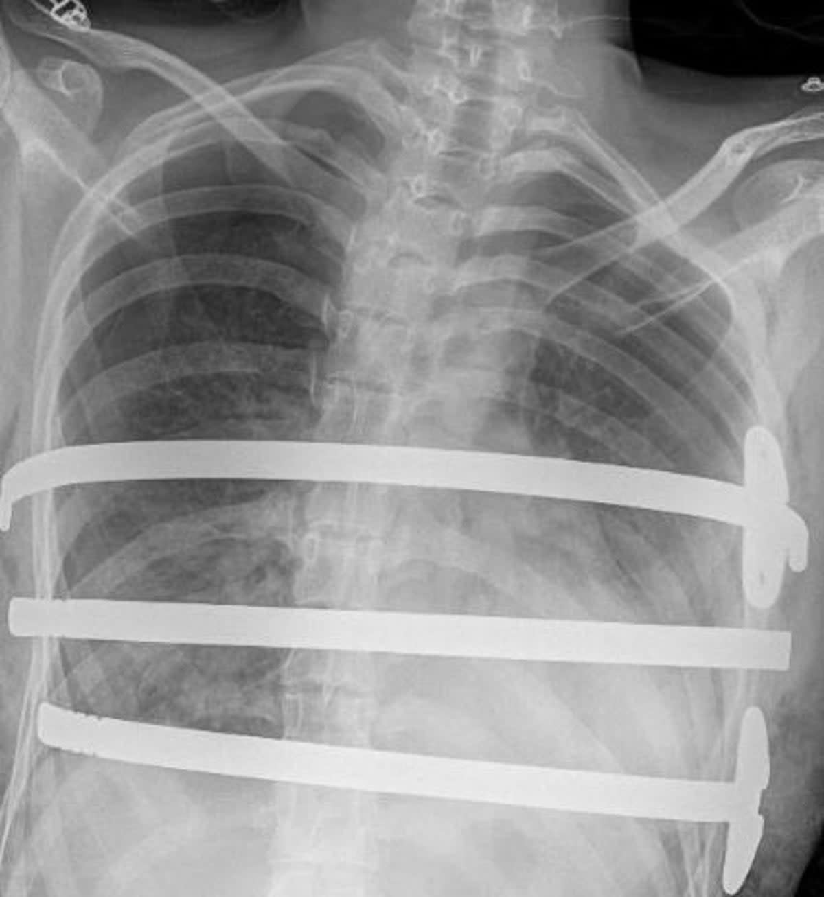 An X-ray of Ellie Musgrove’s chest after she underwent surgery for pectus (Ellie Musgrove)