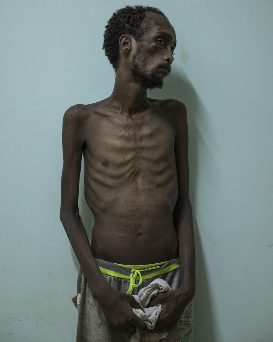 In this Aug. 1, 2019 photo, Ethiopian migrant Abdo Yassin, 23, of Oromo descent, stands for a photo at the Ras Alara Hospital, in Lahj, Yemen. Yassin says he was in a hosh locked up and tortured for months because he didn't have the money to pay a ransom. (AP Photo/Nariman El-Mofty)