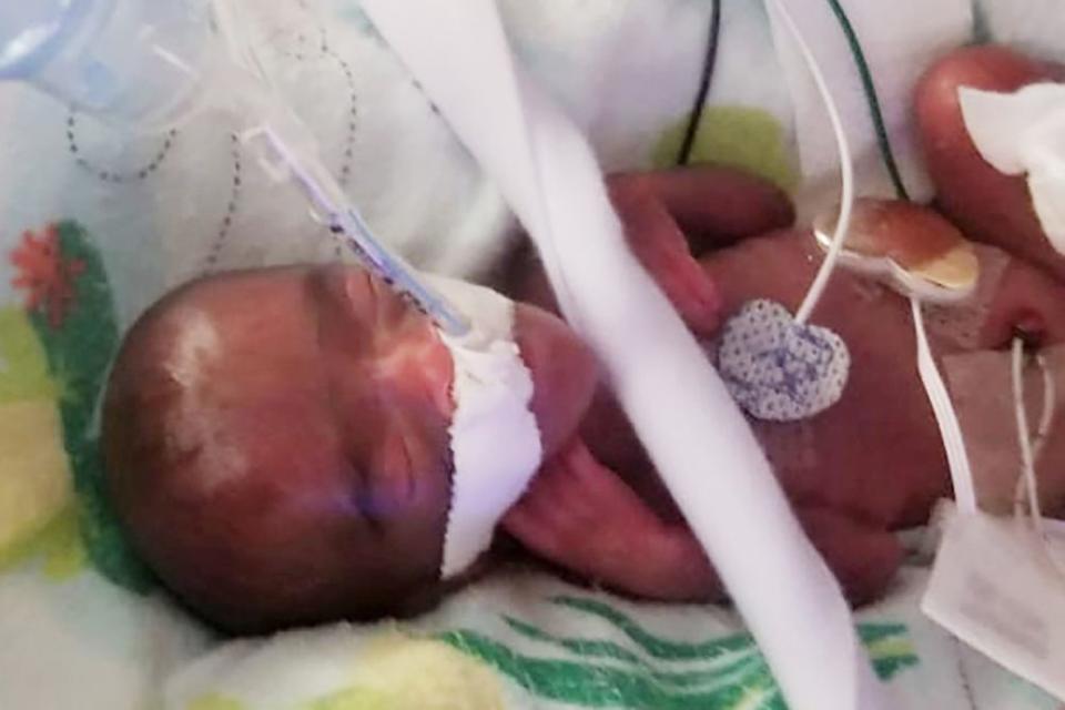 World's Smallest Surviving Baby Goes Home from San Diego Hospital