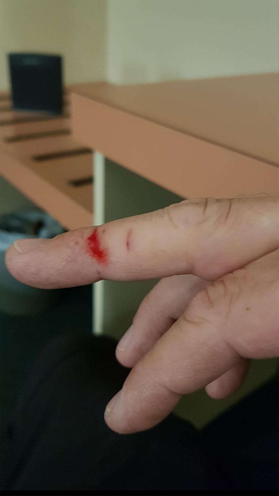 Carlton dry beer changes bottles: Beer drinkers have posted photos of cuts to their hands, allegedly from the new ring pull tops. 