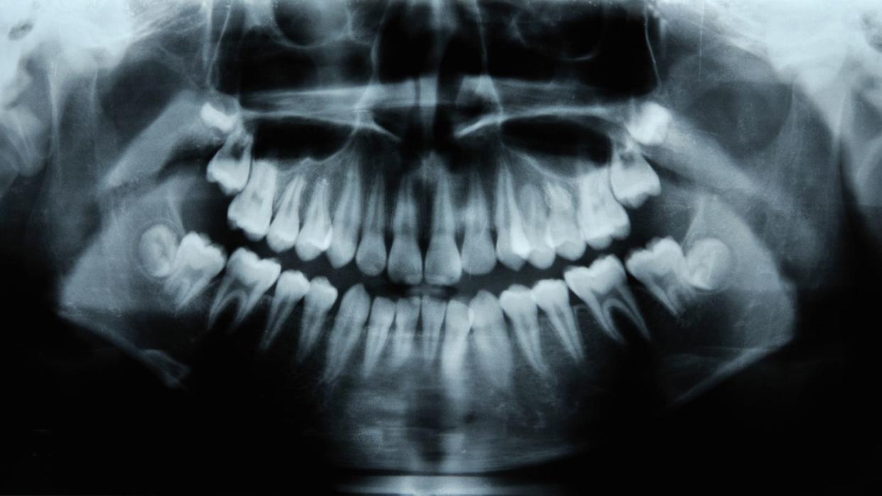 child's dental x rays