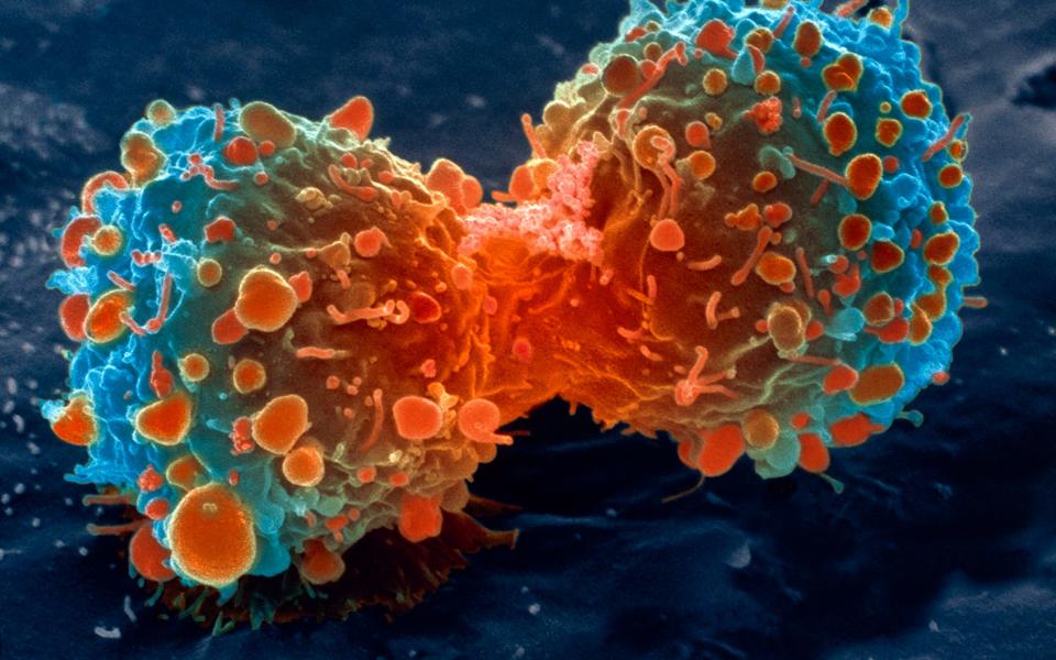 AI techniques allow for greater precision in killing cancerous cells