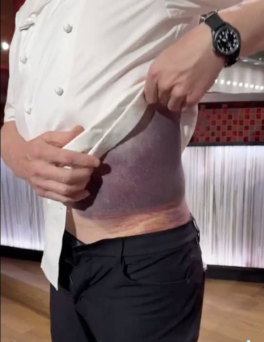 A person lifts their shirt to reveal a large bruise on their side in a kitchen setting. The person's face is not visible