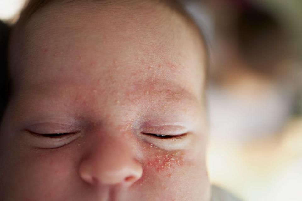 2FNN608 Neonatal acne on a baby face