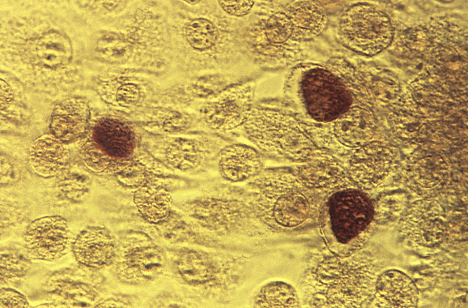 FILE - This 1975 microscope image made available by the the Centers for Disease Control and Prevention shows Chlamydia trachomatis bacteria. U.S. health officials released data Tuesday, April 11, 2023, showing how chlamydia, gonorrhea and syphilis cases have been accelerating, but doctors are hoping an old drug will help fight the sexually transmitted infections. Experts believe STDs have been rising because of declining condom use, inadequate sex education and reduced testing during the COVID-19 pandemic.(Dr. E. Arum, Dr. N. Jacobs/CDC via AP)