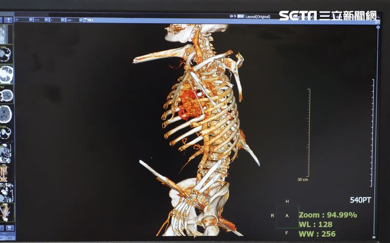 鋼筋貫穿過身體的檢查影像（圖／大林慈院提供）
