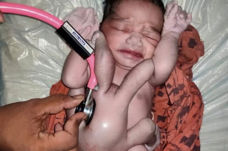 印度一名婦人竟生下擁有「4臂4腿」的嬰兒！（圖／翻攝自推特）