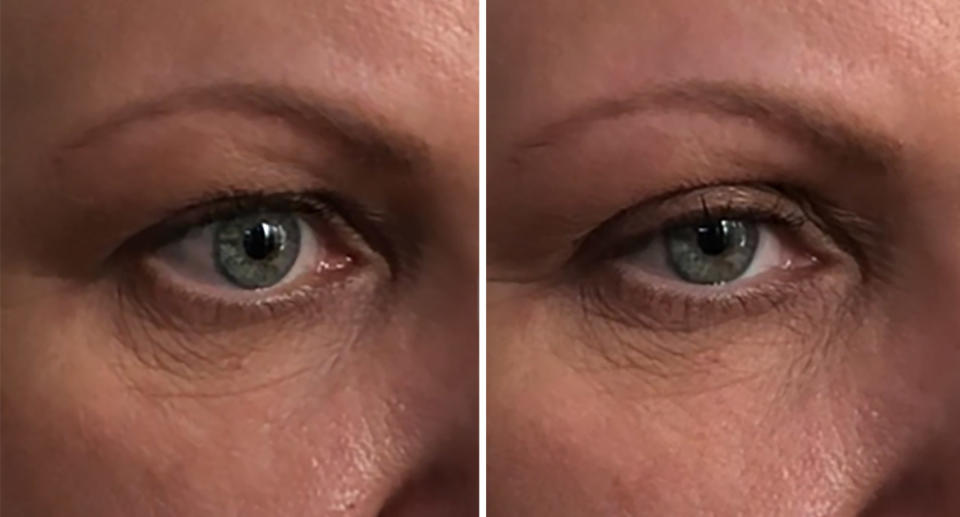 Before and after shots of woman's hooded eyelids fixed with Magic Glue