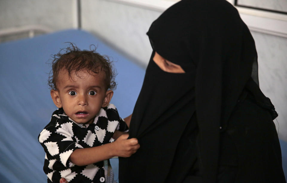 In this Thursday, Sept. 27, 2018 photo, a woman holds her malnourished boy at a feeding center in a hospital in Hodeida, Yemen. With US backing, the United Arab Emirates and its Yemeni allies have restarted their all-out assault on Yemen’s port city of Hodeida, aiming to wrest it from rebel hands. Victory here could be a turning point in the 3-year-old civil war, but it could also push the country into outright famine. Already, the fighting has been a catastrophe for civilians on the Red Sea coast. (AP Photo/Hani Mohammed)