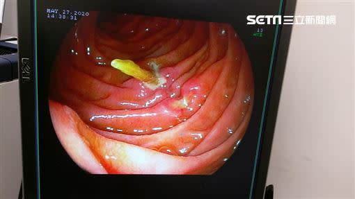 朱先生卡在十二指腸的牙籤。（圖／長安醫院提供）