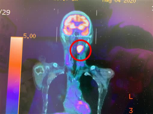 許嘉方強調，近年，口咽癌、口腔癌等頭頸類癌症患者有年輕化的趨勢。（圖／衛生福利部彰化醫院提供）