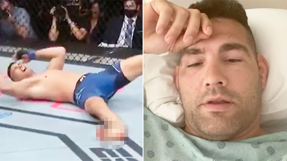 Chris Weidman is seen here in pain at UFC 261 and on his Florida hospital bed. 