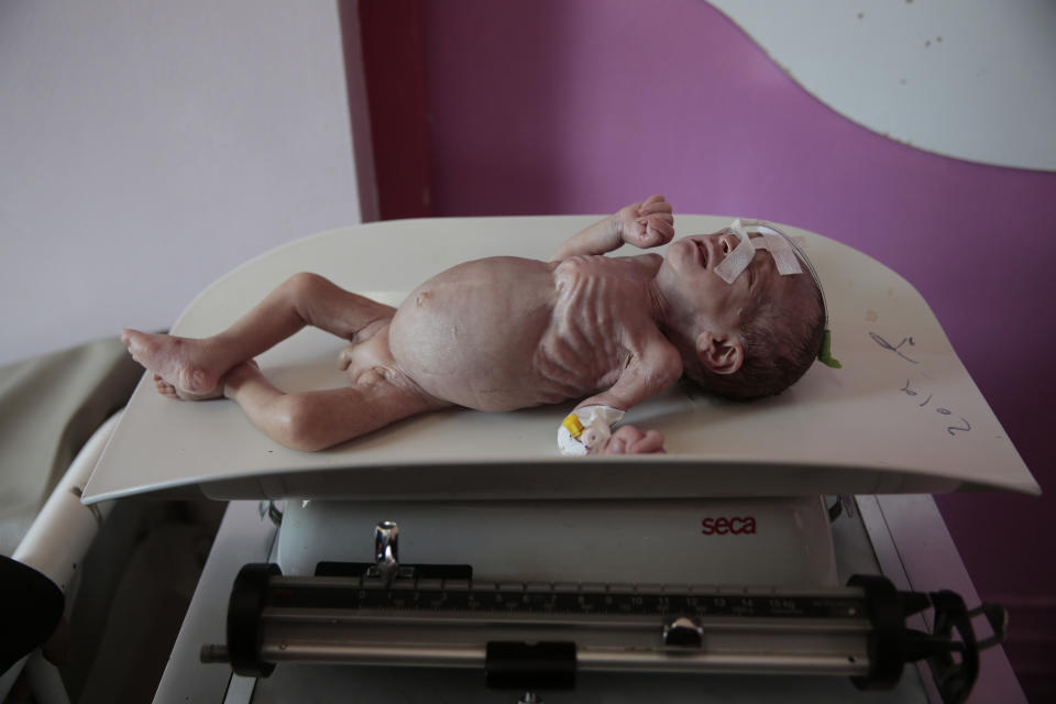 File - In this Nov. 3, 2020 file photo, a malnourished boy Maher Ahmed is placed on a scale at a feeding center at Al-Sabeen hospital in Sanaa, Yemen. On Sunday, Feb. 28, 2021, the U.N. Office for the Coordination of Humanitarian Affairs warned that more than 16 million people in Yemen would go hungry this year, with already some half a million living in famine-like condition in the conflict-wrecked country. The stark warning comes a day before a pledging conference co-hosted by Sweden and Switzerland. (AP Photo/Hani Mohammed, File)