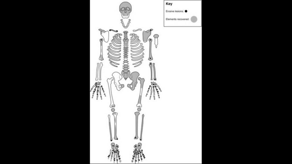 Se encontraron lesiones y hoyos alrededor de las articulaciones del antiguo esqueleto, una presentación típica de la artritis reumatoide, dijeron los investigadores.