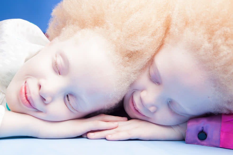 <p>Las niñas tienen un síndrome llamado albinismo, es un trastorno genético que causa la carencia de pigmento en la piel y el cabello<b>.</b> Las niñas nacieron en Brasil, pero sus padres son originarios de Guinea-Bisáu, al oeste de África. </p>