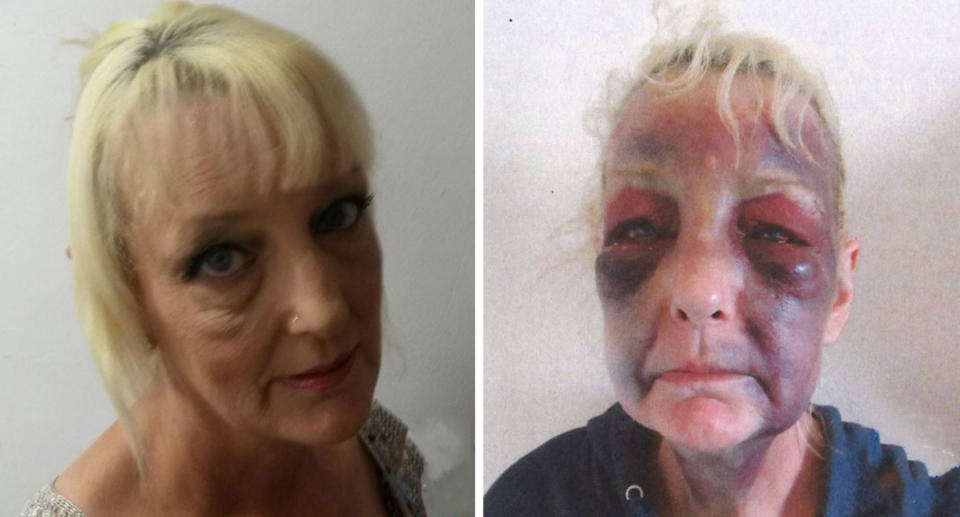 Pictured is Lynn Hart with and without a badly bruised face she suffered as a victim of domestic violence.