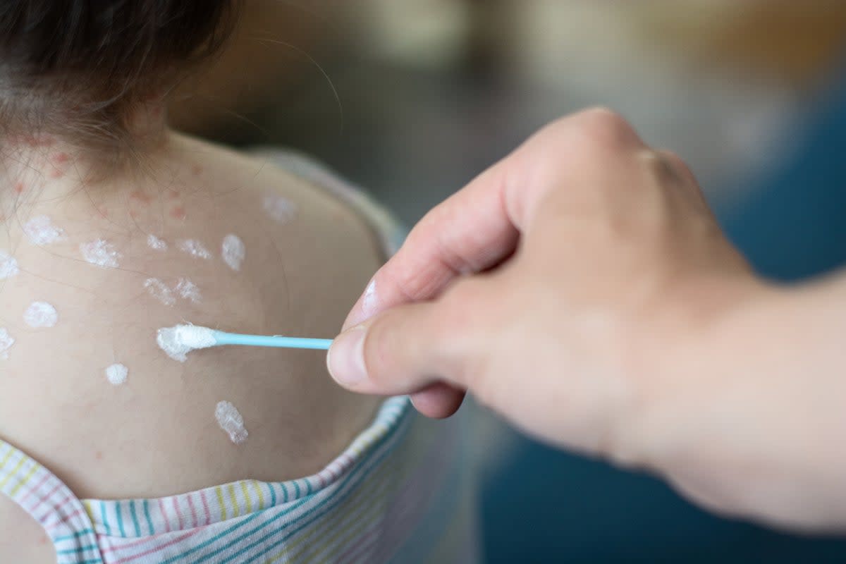 Chickenpox is extremely common and spreads easily among children – resulting in that telltale itchy red rash (Getty Images)