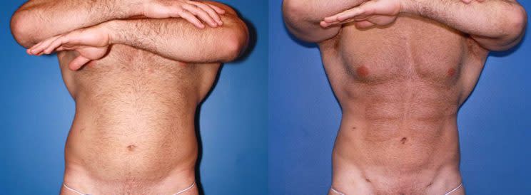 Male liposuction