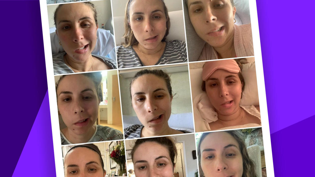 Photos of Elena Sheppard, who has facial paralysis, struggling to smile.