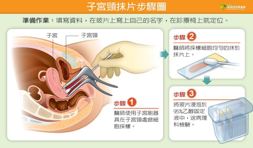 子宮頸抹片步驟圖