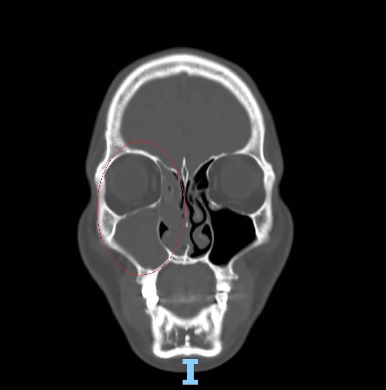許嘉方醫師表示，電腦斷層顯示黃先生右側鼻腔鼻竇幾乎全塞住。（圖／翻攝自彰化醫院臉書）