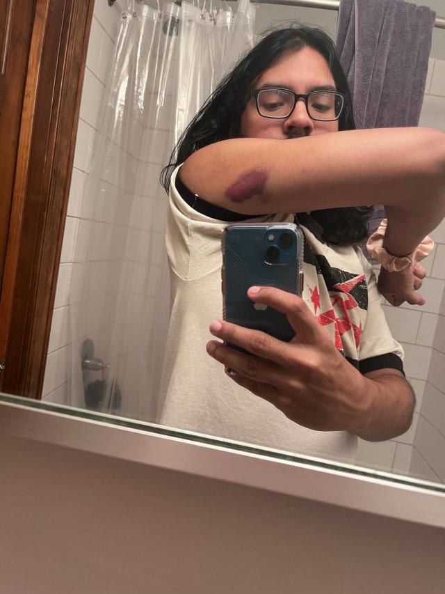 Battle scars. This reporter received this bruise after going back-first into a tree on a float trip at River Ranch Resort in Noel, Missouri in August 2022.