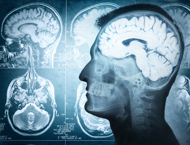 <span class="caption">Many parts of the brain are involved in creating personal memories.</span> <span class="attribution"><a class="link " href="https://www.shutterstock.com/image-photo/conceptual-image-man-side-profile-showing-311949818?src=hTawT6ABsJ2No30gQrXQ8Q-1-24" rel="nofollow noopener" target="_blank" data-ylk="slk:Triff/shuttestock;elm:context_link;itc:0;sec:content-canvas">Triff/shuttestock</a></span>