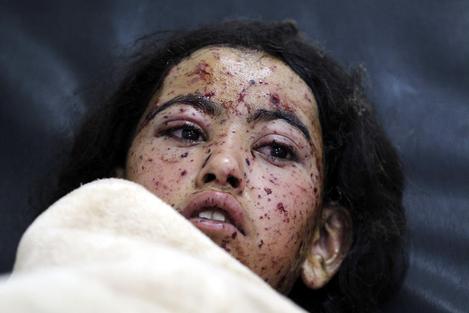 A wounded Yemeni child after Saudi-led airstrike in Sana’a
