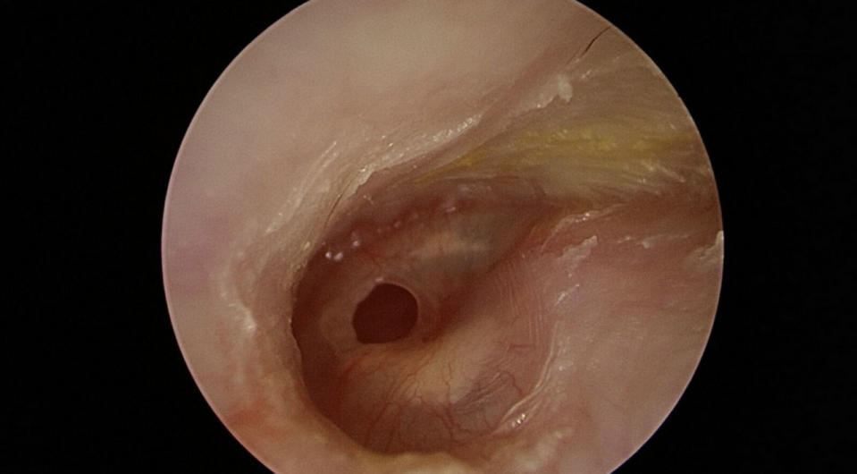 婦人接連感冒竟「聽不清、耳流湯」 醫師一看耳膜破大洞了 259