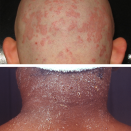 <p><strong>What it looks like</strong>: <a href="https://nationaleczema.org/eczema/types-of-eczema/seborrheic-dermatitis/" rel="nofollow noopener" target="_blank" data-ylk="slk:Seborrheic dermatitis" class="link ">Seborrheic dermatitis</a> is a form of eczema that is characterized by scaly, oily or greasy patches of skin, usually on the scalp.</p><p><strong>Other symptoms to note</strong>: This condition is itchy and can cause dandruff and buildup on the scalp. It’s also common on other oily areas, like the <a href="https://www.mayoclinic.org/diseases-conditions/seborrheic-dermatitis/symptoms-causes/syc-20352710" rel="nofollow noopener" target="_blank" data-ylk="slk:face and chest" class="link ">face and chest</a>, and can be difficult to treat. Dr. Zeichner explains that although the exact cause of seborrheic dermatitis is unknown, the body overreacts to yeast on oily parts of the skin, causing the thick, flaky buildup. To treat dandruff, use one of these best of the <a href="https://www.prevention.com/beauty/hair/g19876075/best-dandruff-shampoo/" rel="nofollow noopener" target="_blank" data-ylk="slk:best dandruff shampoos" class="link ">best dandruff shampoos</a>.</p><p><em>Top image credit: <a href="https://commons.wikimedia.org/wiki/File:Seborrhoeic_dermatitis_head.jpg" rel="nofollow noopener" target="_blank" data-ylk="slk:Amras666" class="link ">Amras666</a></em></p>