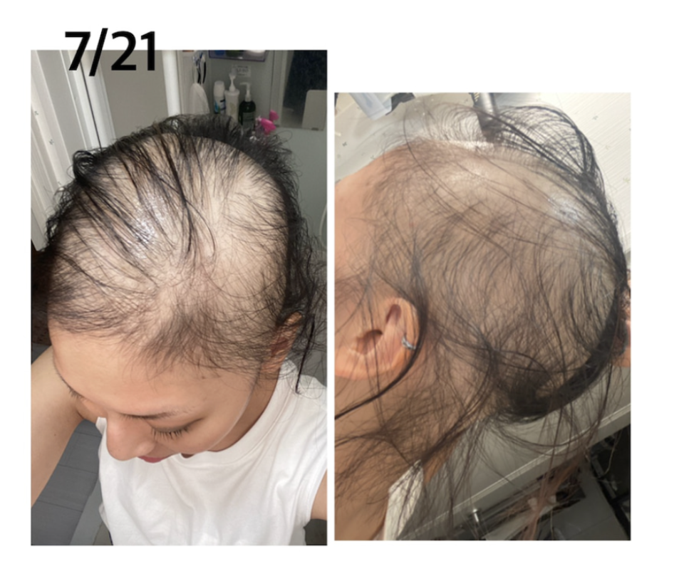 一名日本女網友接種莫德納疫苗後，開始出現掉髮現象。（翻攝ameblo.jp網站）