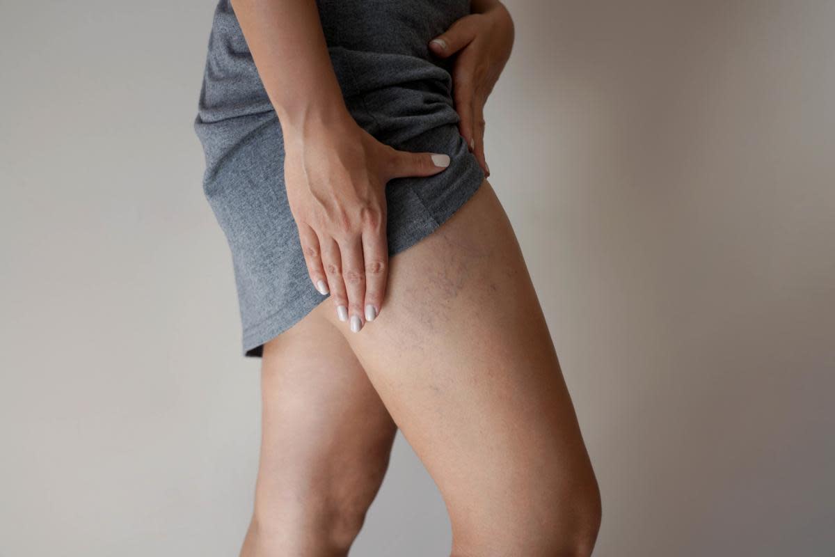 Approximately 20% of people will experience varicose veins at some point in their lives, according to the National Library of Medicine.  <i>(Image: Getty Images)</i>