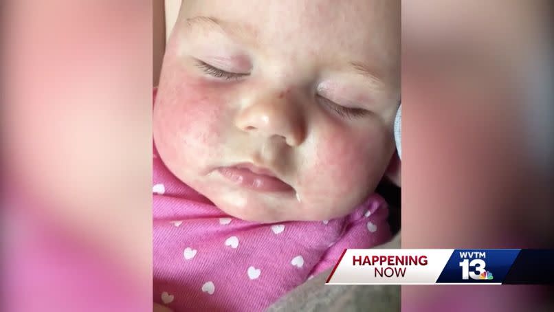 A 5-month-old girl in Alabama is the state's first confirmed case of the measles. (Photo: WVTM)