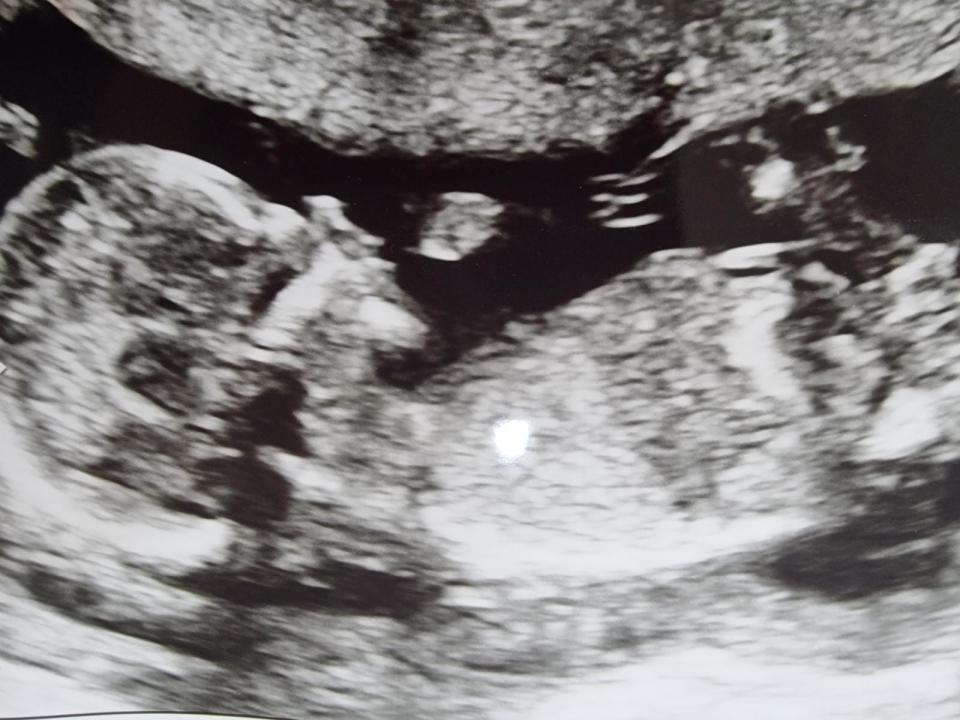 The ultrasound scan of Dorothea taken during the 16th week of Fenrych's pregnancy detected the issues with her heart.