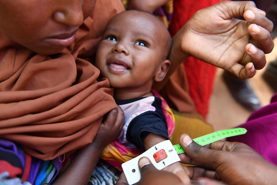 <p>An acute malnourished child is measured the arm perimeter by a UNICEF staff inside the Internally Displaced Persons camp in Doolow, a border town with Ethiopia, in Somalia, on March 20, 2017. One out of seven Somali children dies before its fifth birthday, and acute malnutrition weakens the immune system, which makes affected children more susceptible to disease such as measles, a UN spokesman told reporters earlier this month. In Somalia, drought conditions are threatening an already fragile population battered by decades of conflict. Almost half the population are facing acute food insecurity and in need of humanitarian assistance. Some 185,000 children are expected to suffer from severe acute malnutrition this year, and the figure may rise to 270,000 in the next few months, the UN Children’s Fund (UNICEF) said in February. (Photo: Xinhua/Sun Ruibo via Getty Images) </p>