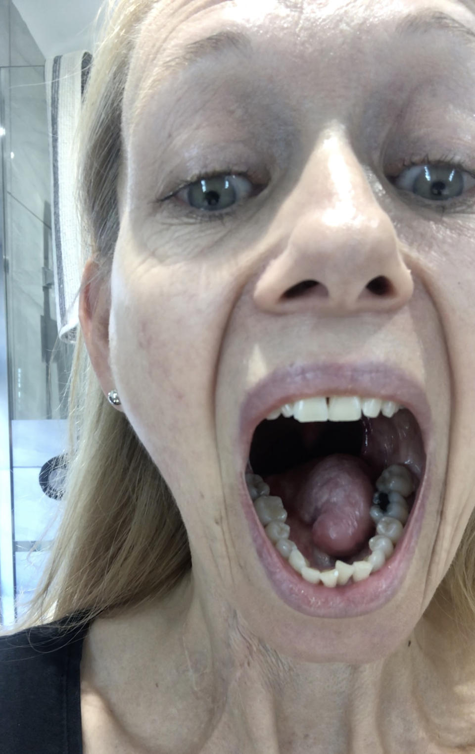 Karen was shocked to discover the persistent ulcer on her tongue was due to underlying tongue cancer [Photo: Caters]