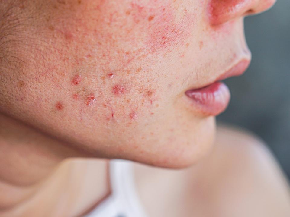 A close-up photo of acne on a person's cheek.