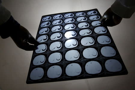 Cancer patient Cao Dongxian poses with CT scan images of his intestine at a hotel room where he stays, near the Peking Union hospital, during an interview with Reuters in Beijing, China, April 6, 2016. REUTERS/Kim Kyung-Hoon